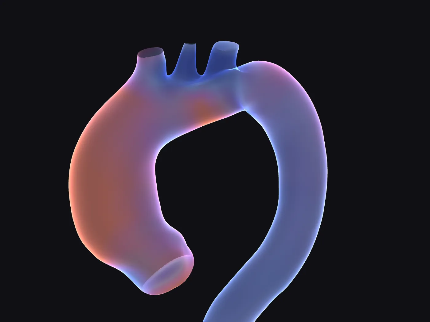 Patient-specific 3D aorta coloured by local radius, from narrow in blue to dilated in coral