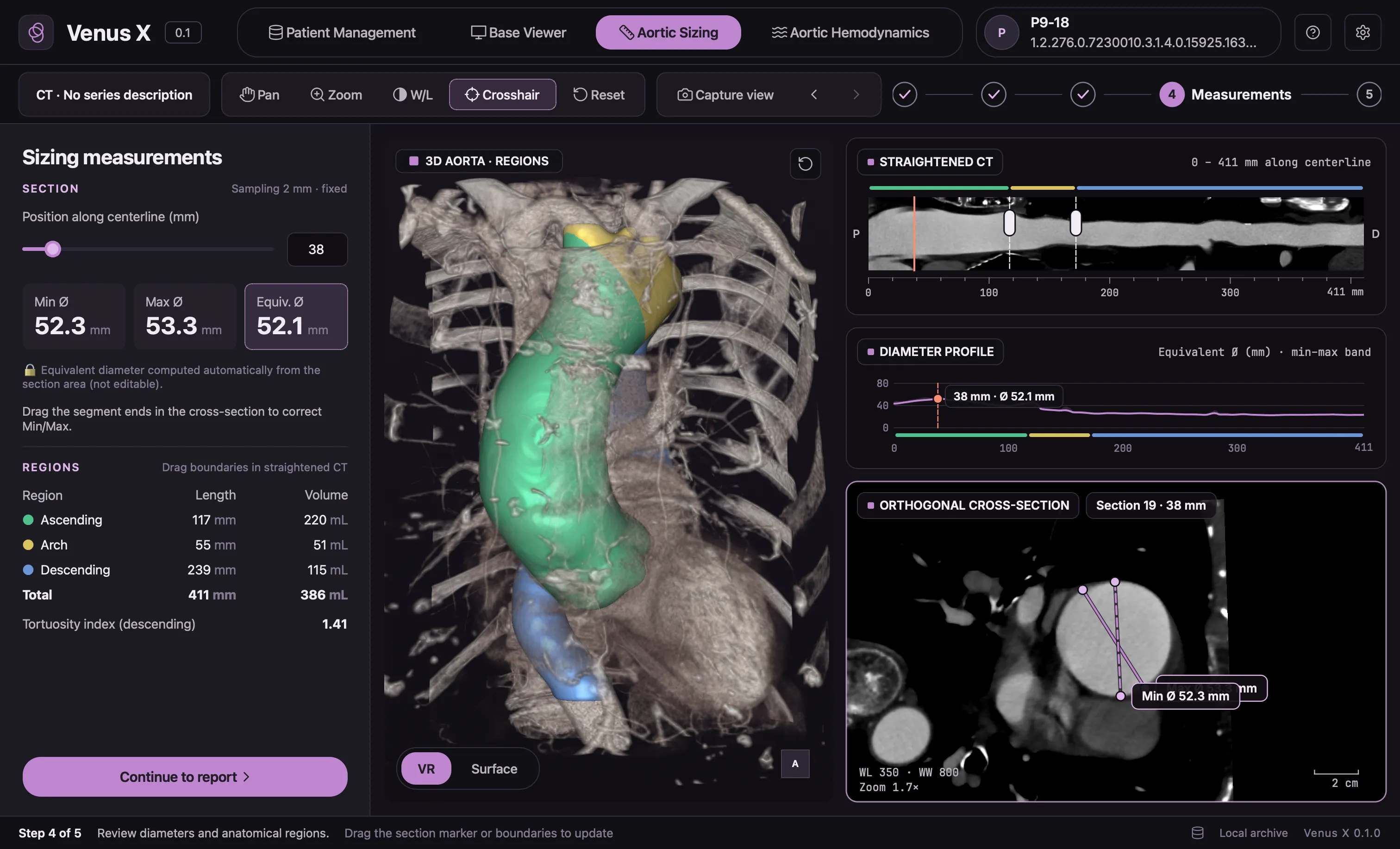 VenusX Sizing on an anonymised thoracic CT: 3D aorta coloured by region, straightened CT, diameter profile and orthogonal cross-section